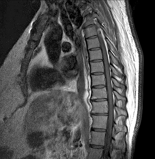 MRI Thoracic Spine Scan (AI Enhanced)